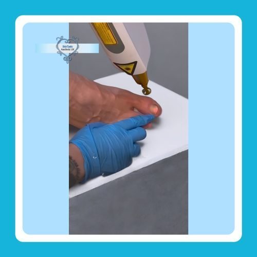 Laser Fungal Nail Infection CPD Training Course