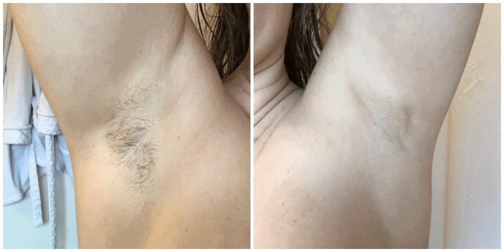 Before-and-After-Laser-Hair-Removal
