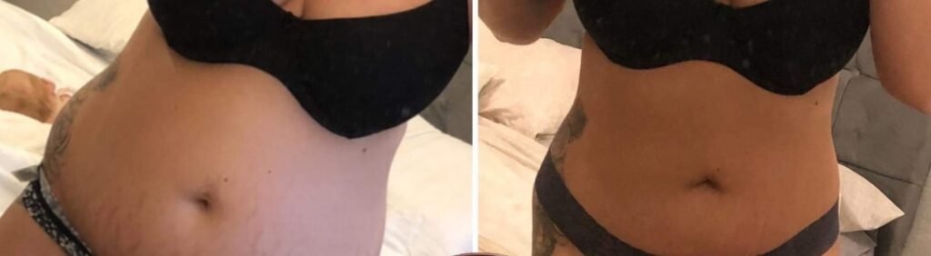 Example of abdomen before and after body contouring treatment