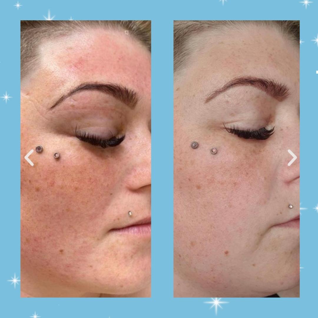 pigmentation2