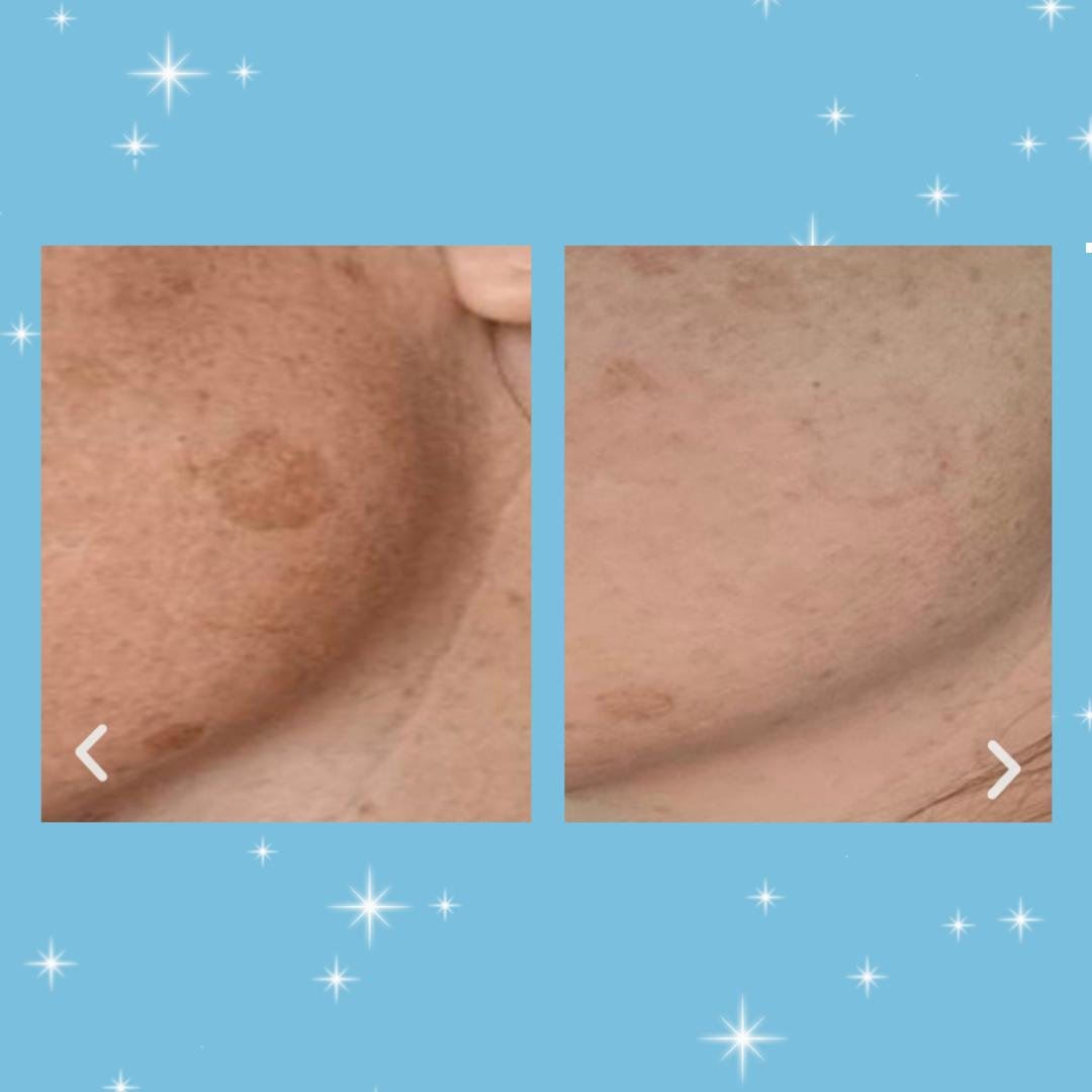 pigmentation1