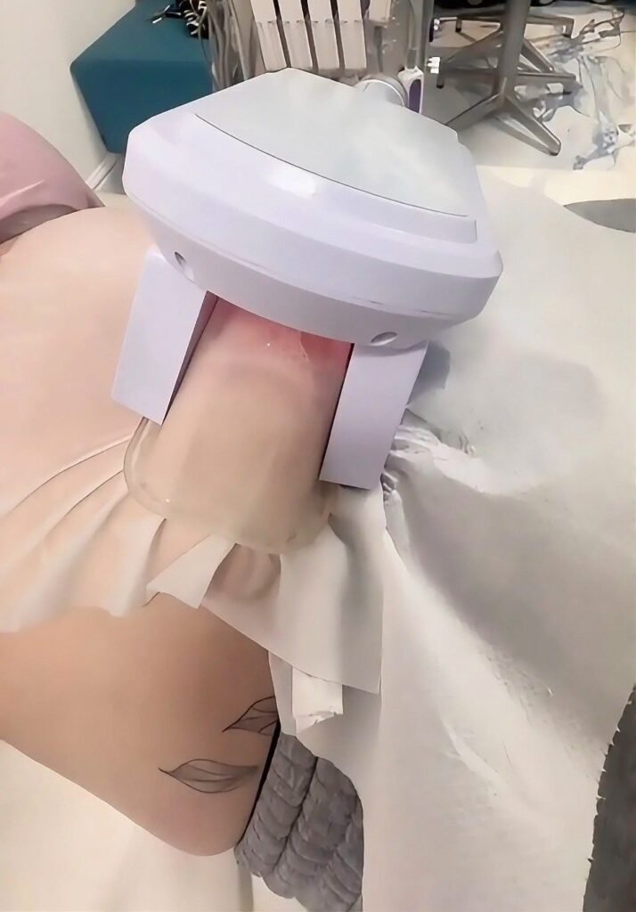 Close-up of the Fat Freeze cryolipolysis applicator in use during training