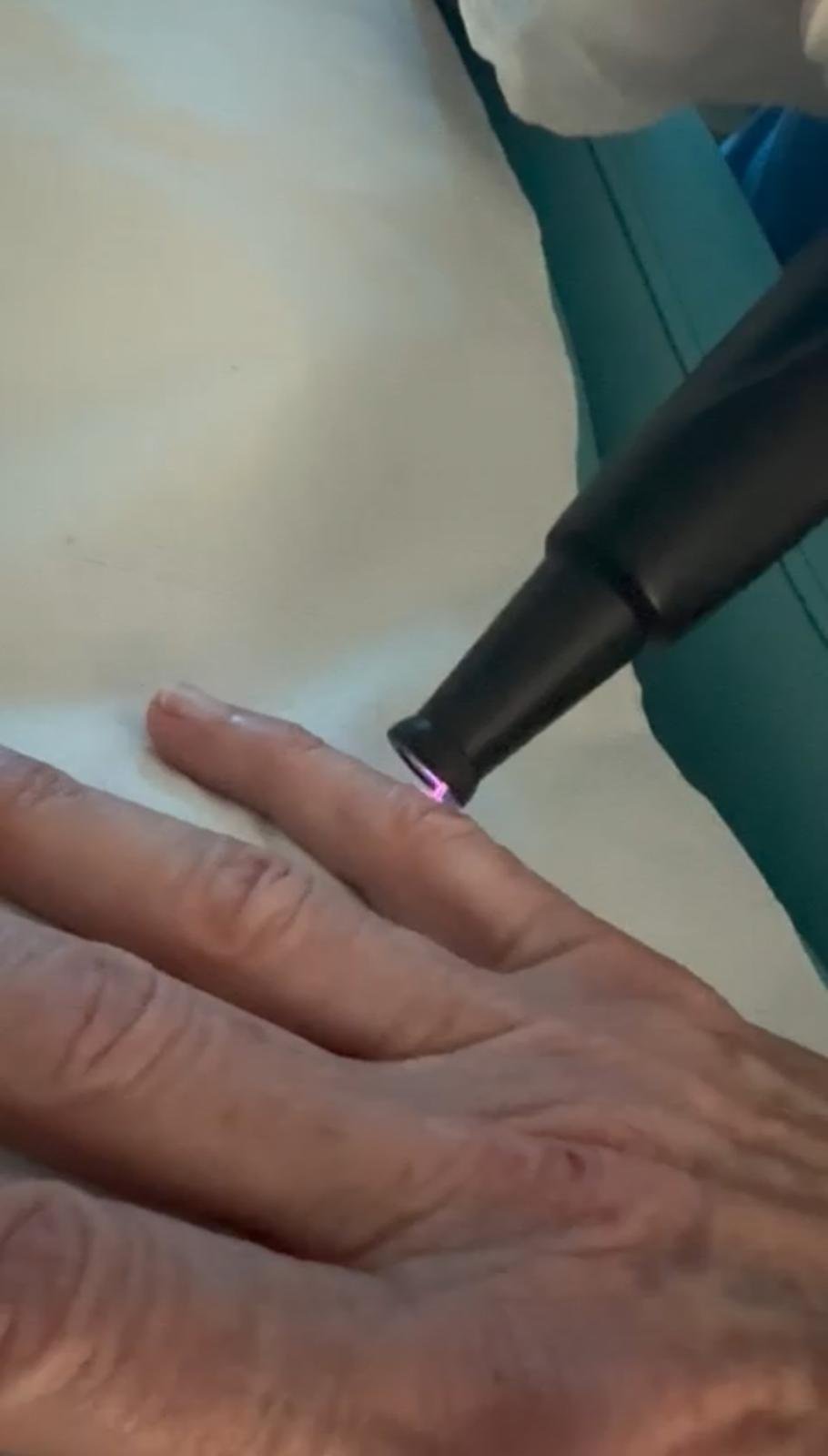 SkinCool+ – Dual Function Cold & Thermal Plasma System - Image 10