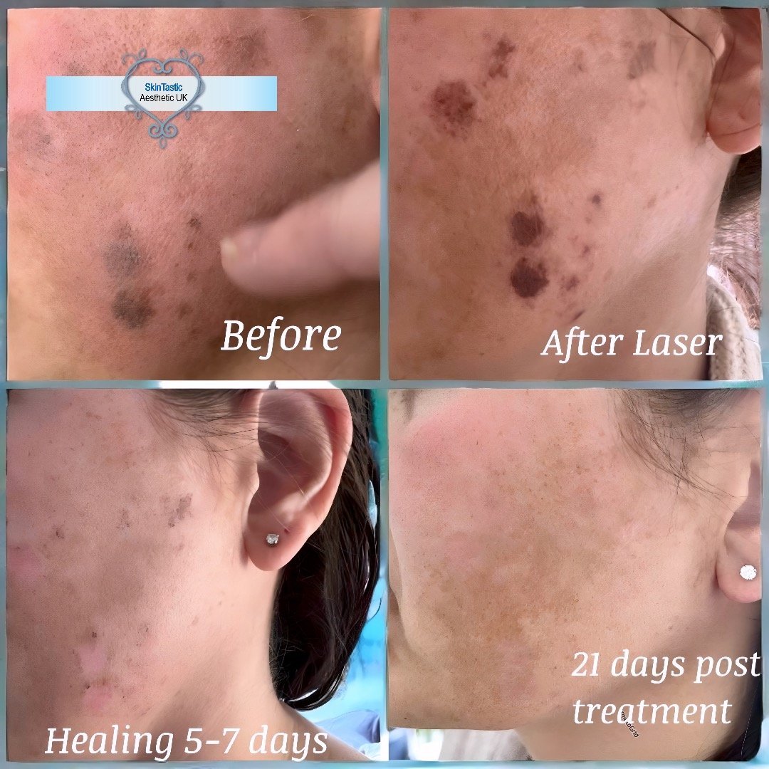 Laser pigmentation reduction on the face at Skintastic Southampton
