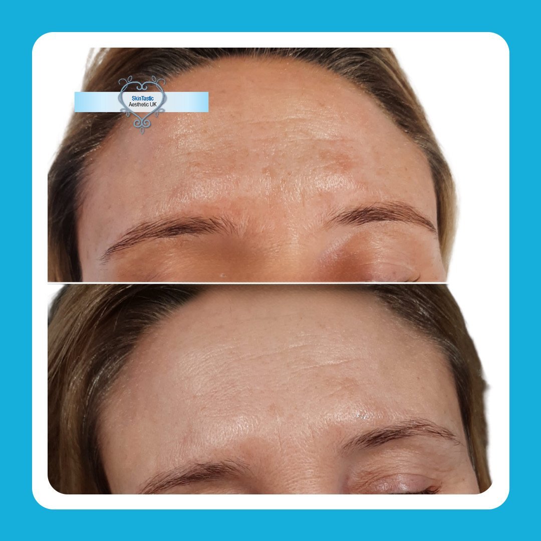 A laser pigmentation reduction result at our clinic at Skintastic Southampton