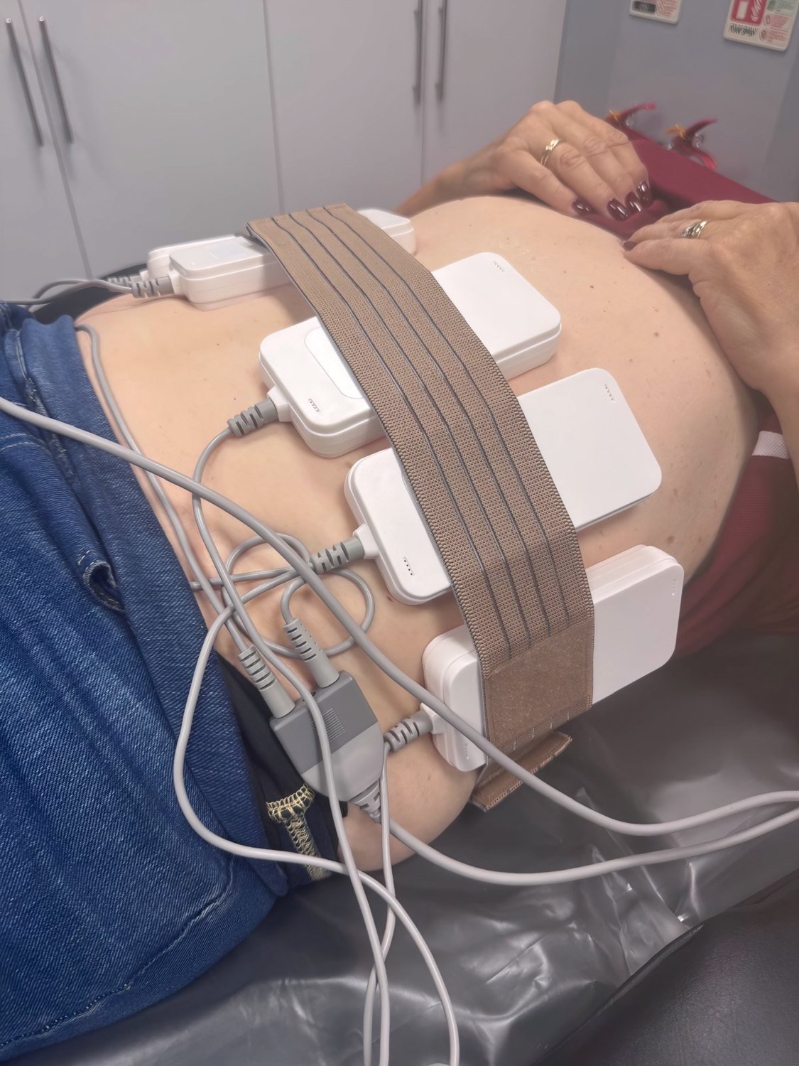 Applicator placement on the abdomen