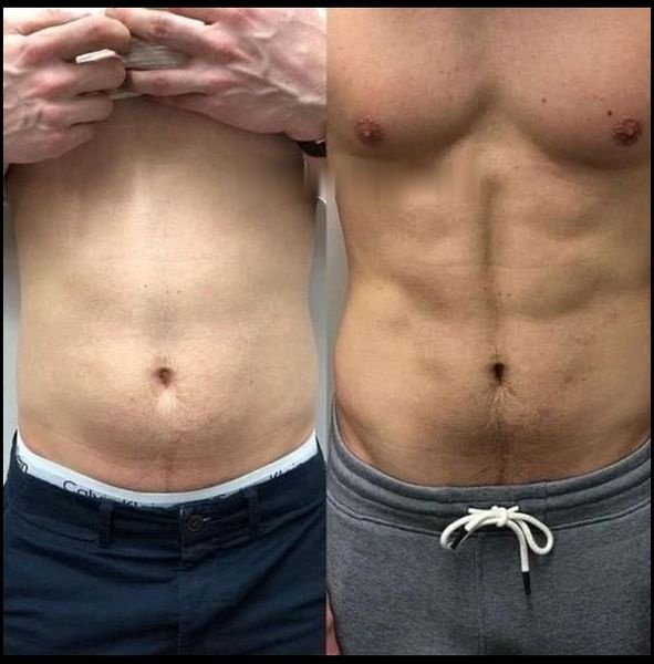 Abdominal definition before and after EMS body sculpting at Skintastic Southampton