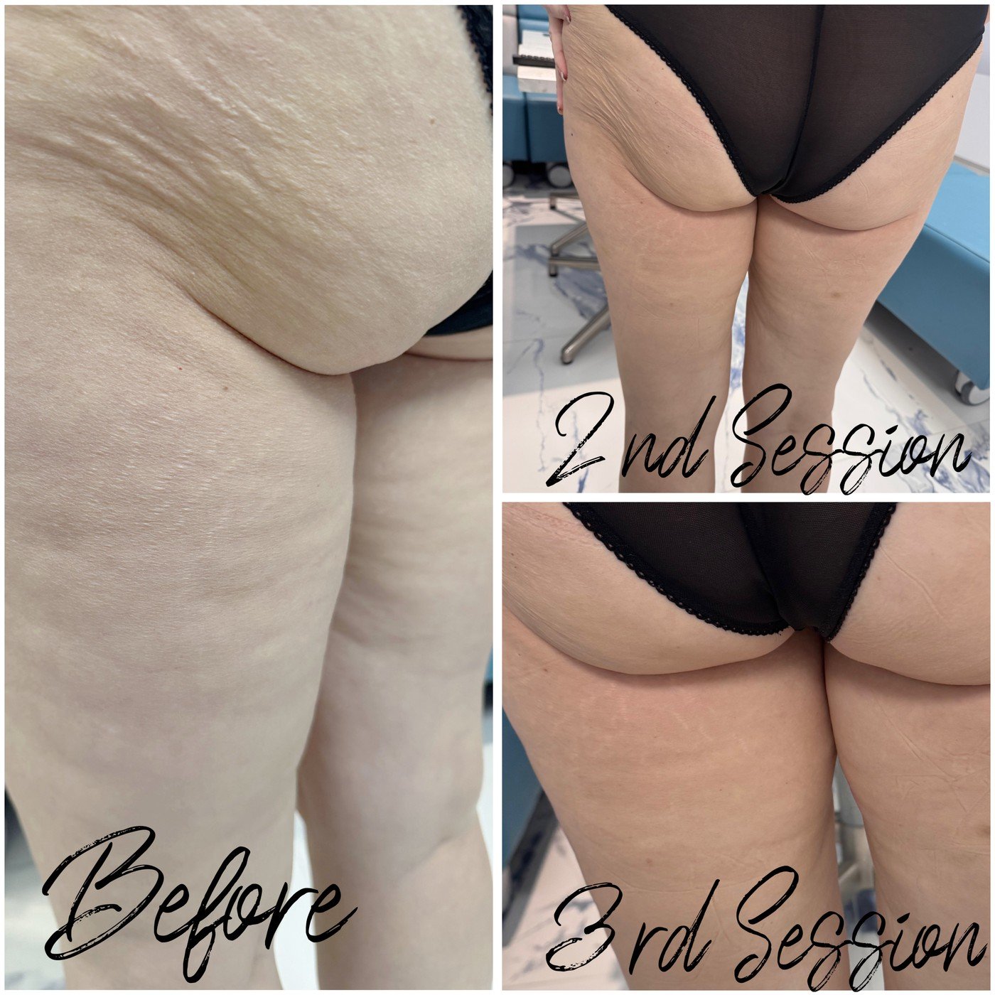 Client progress after three EMS body sculpting sessions at Skintastic Southampton
