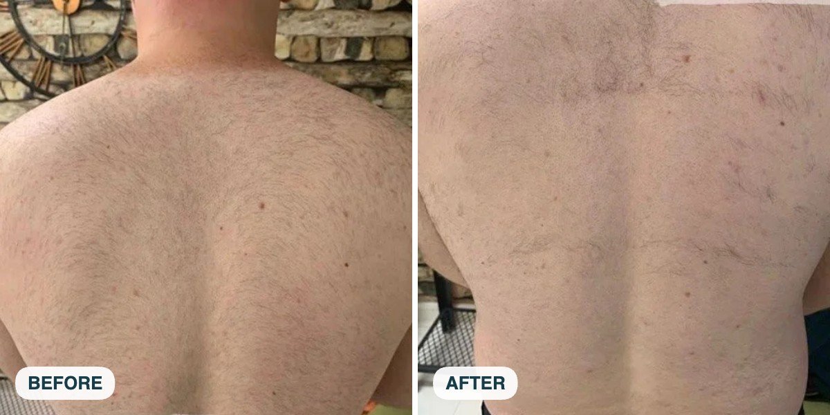 Male back laser hair removal before and after three sessions at Skintastic Southampton