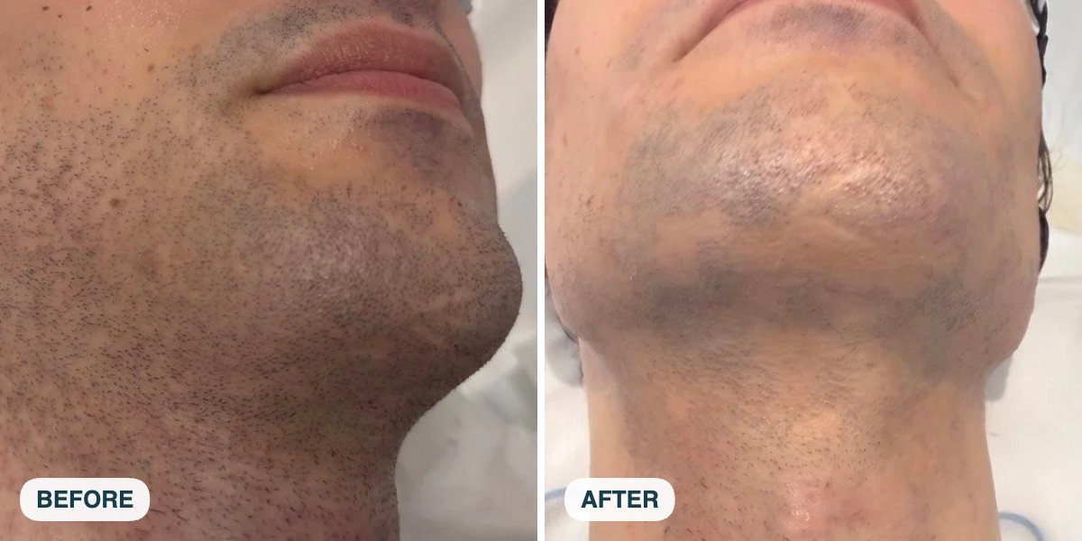 Beard line and neck laser hair removal before and after at Skintastic Southampton