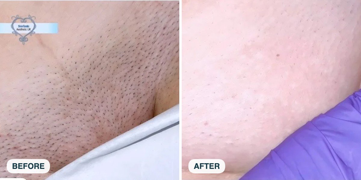 Bikini line laser hair removal before and after at Skintastic Southampton