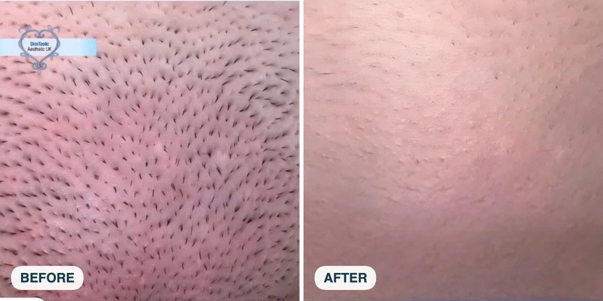 Neck and chin laser hair removal before and after at Skintastic Southampton
