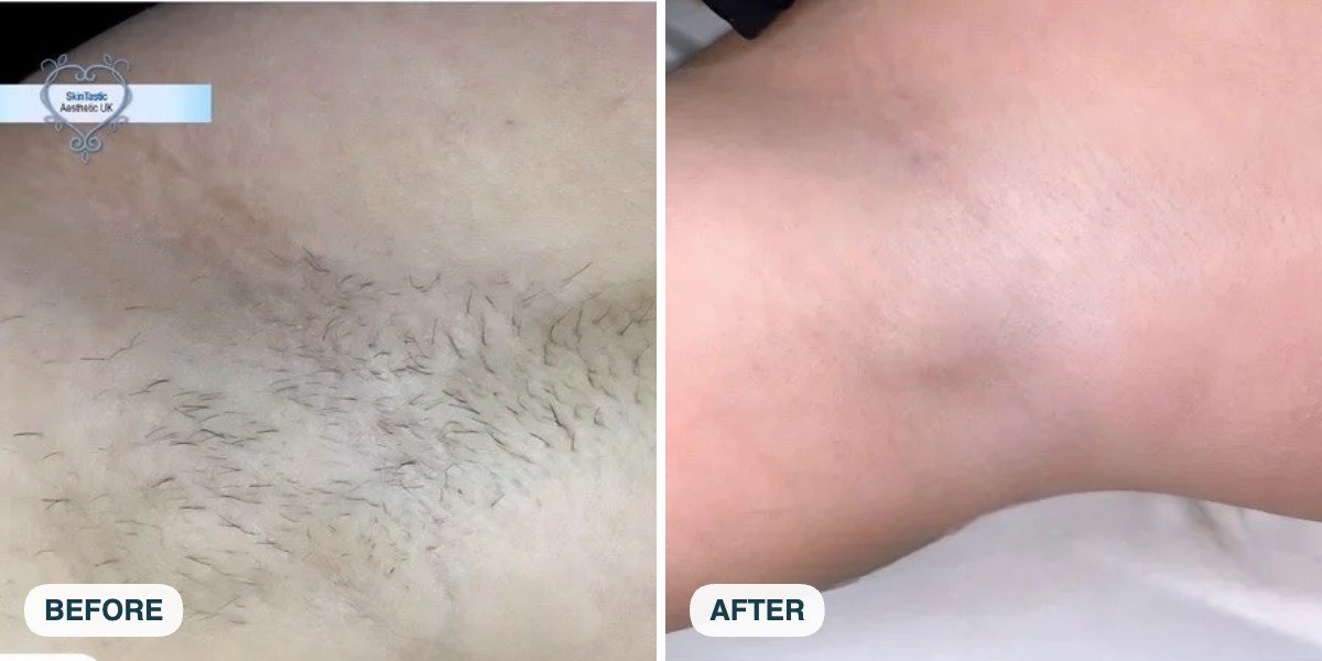 Underarm laser hair removal before and after at Skintastic Southampton