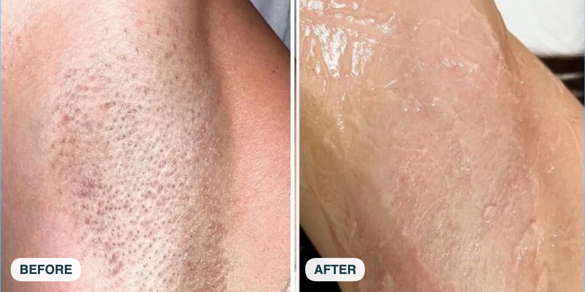 Underarm laser hair removal, reduced density and less ingrown irritation