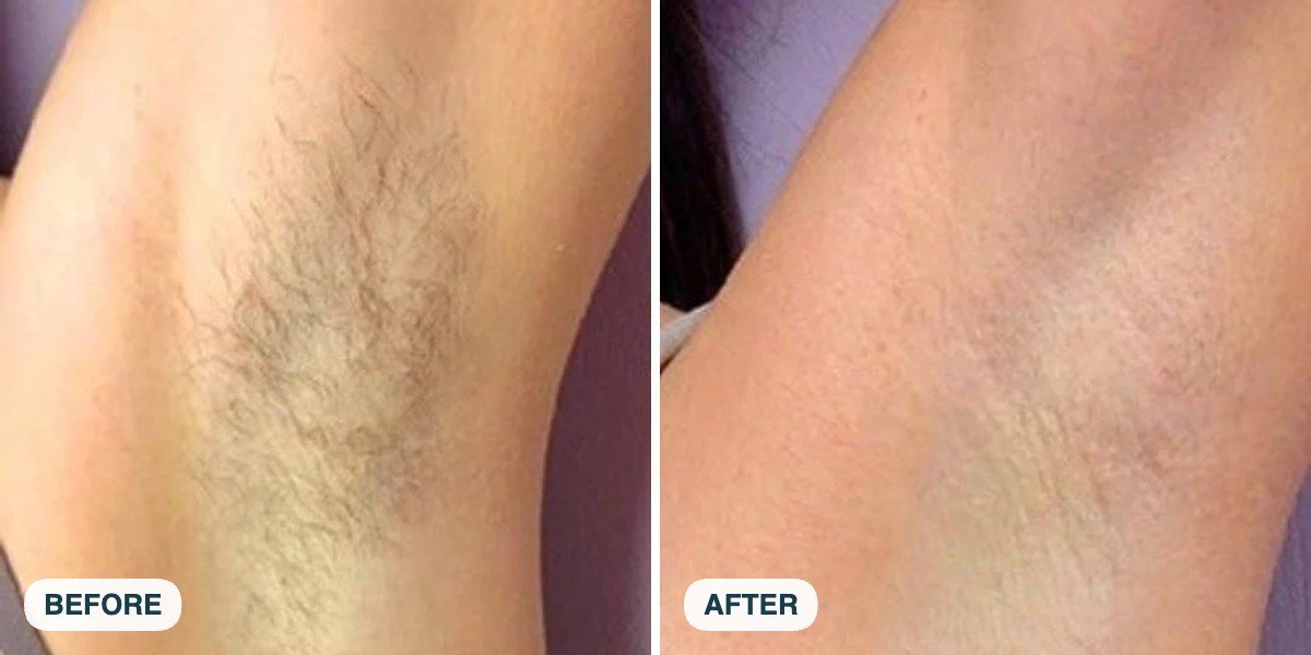 Underarm laser hair removal before and after result
