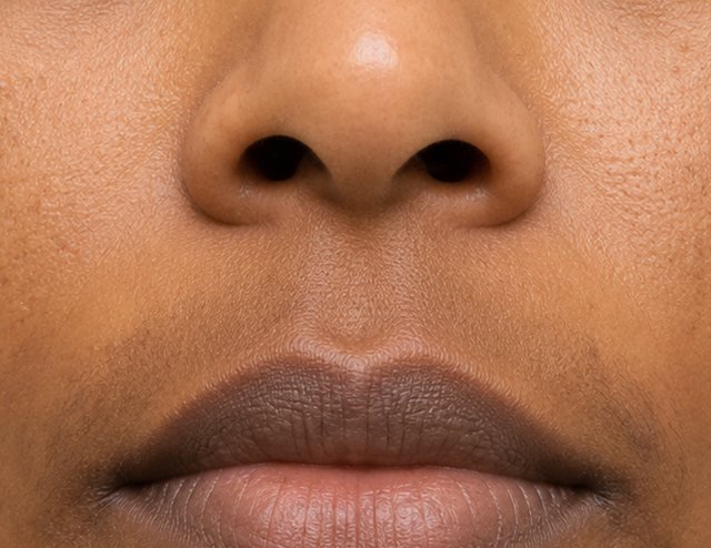 Example of lip hyperpigmentation affecting the upper and lower lip border on deeper skin