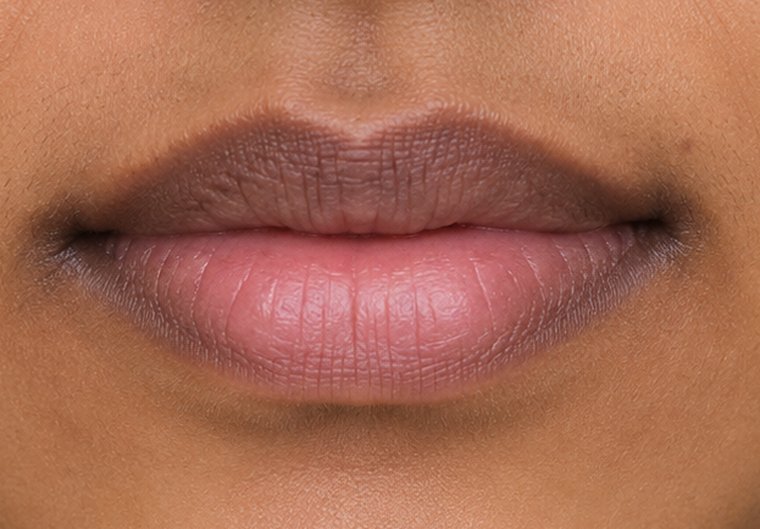 Example of lip hyperpigmentation on brown skin
