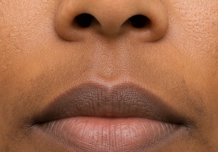 Example of lip hyperpigmentation affecting the upper and lower lip
