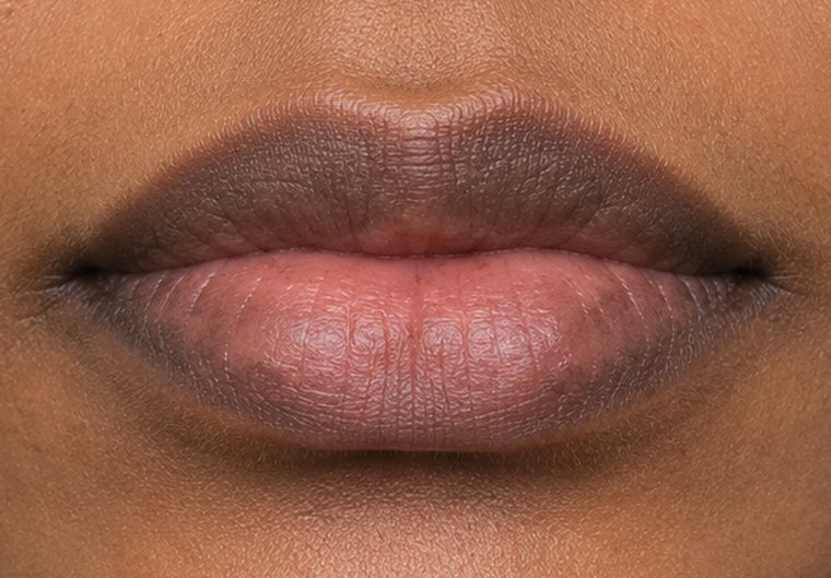 Example of uneven lip pigmentation on deeper skin