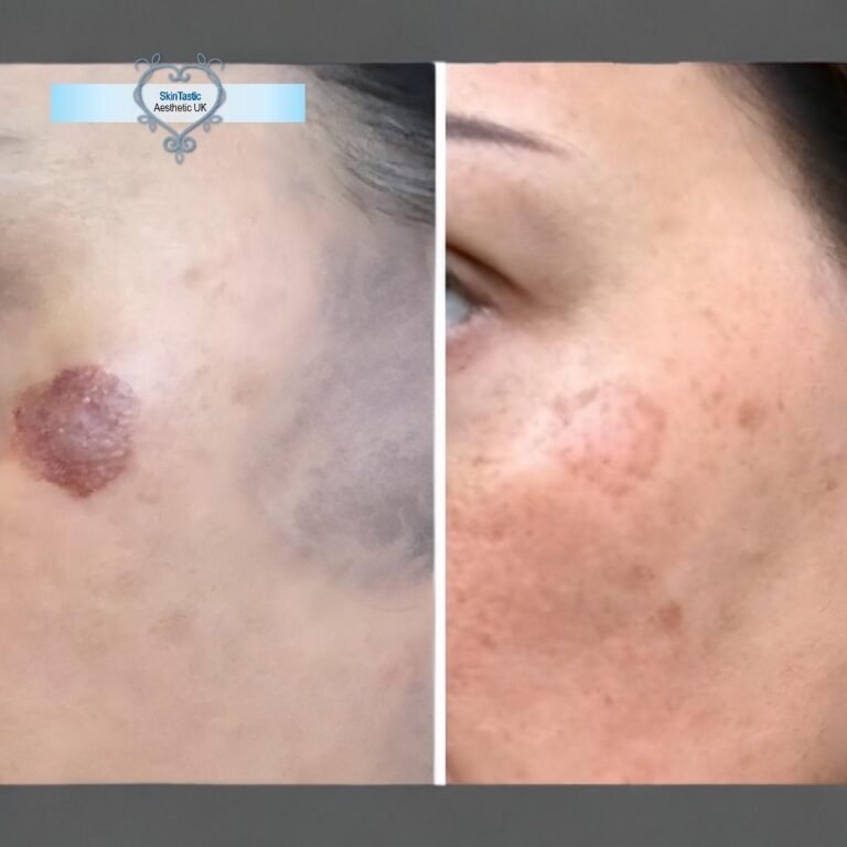 Raised pigmented lesion and sun damage on the cheek before and after laser pigmentation treatment at Skintastic