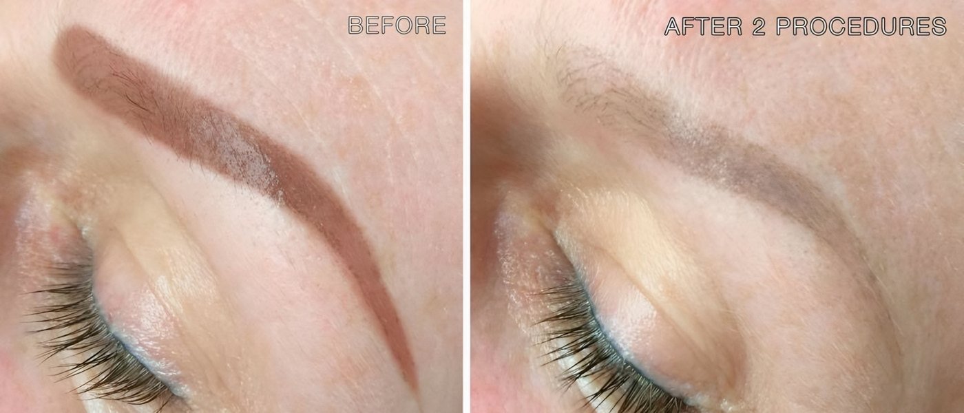 Semi-permanent makeup brow before removal and after two laser removal treatments