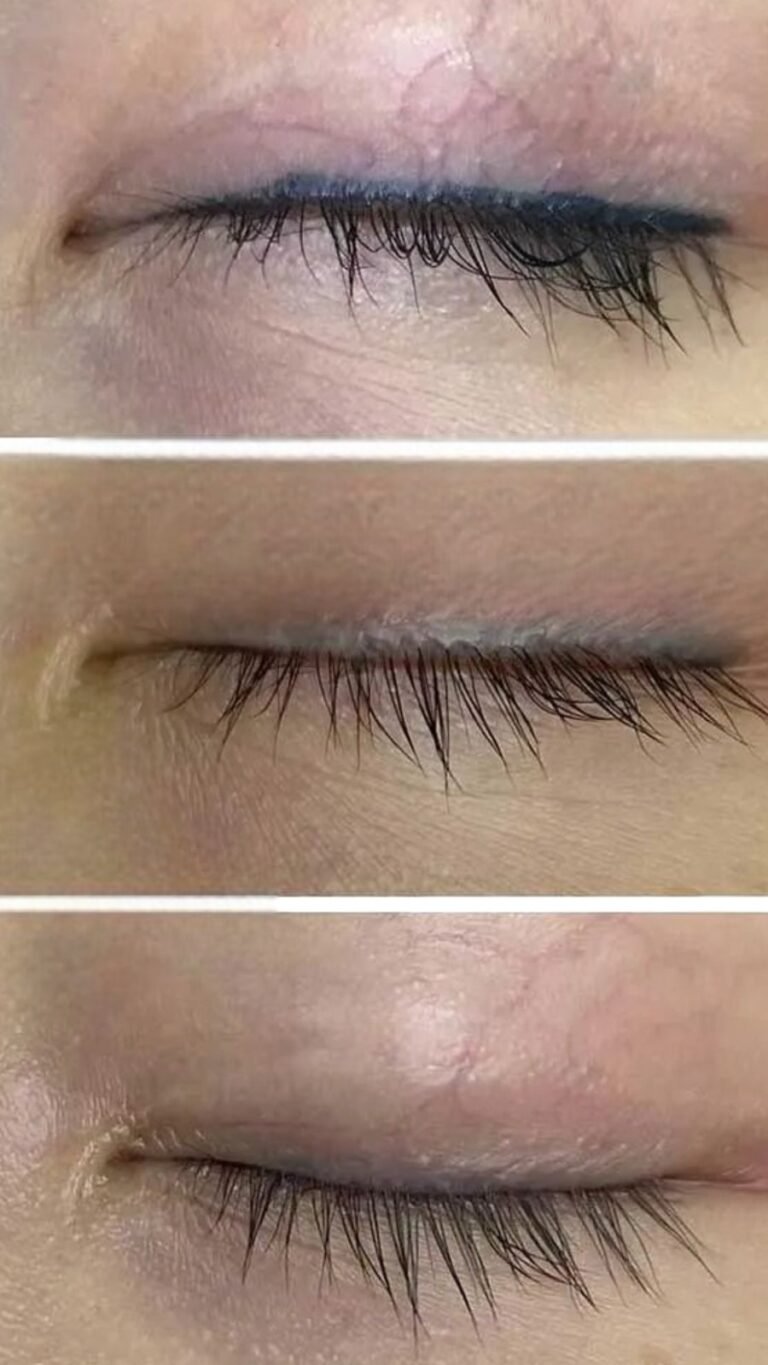 Semi-permanent eyeliner removal progression over three stages of laser treatment at Skintastic