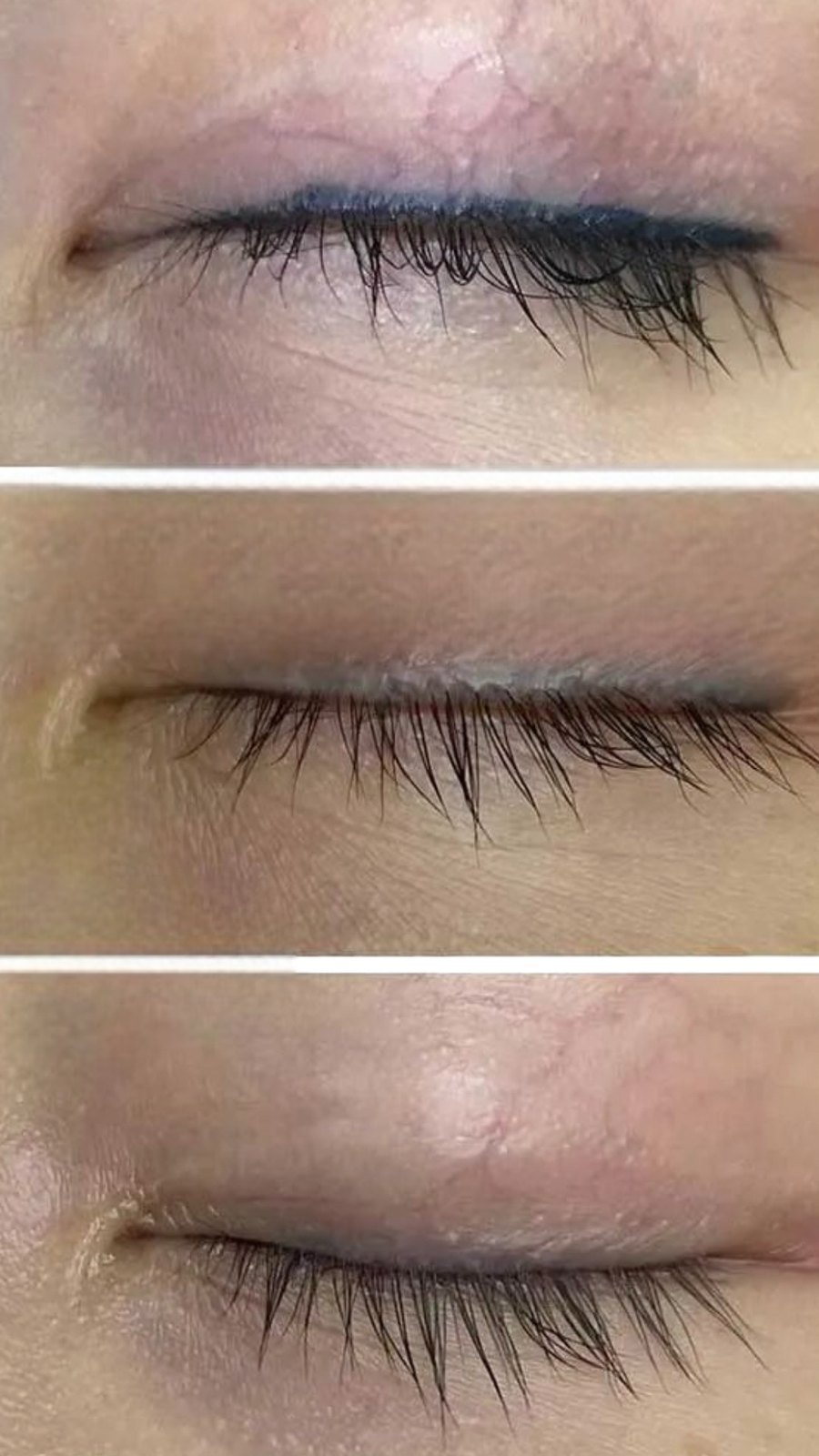 Semi-permanent eyeliner removal shown across three stages of treatment