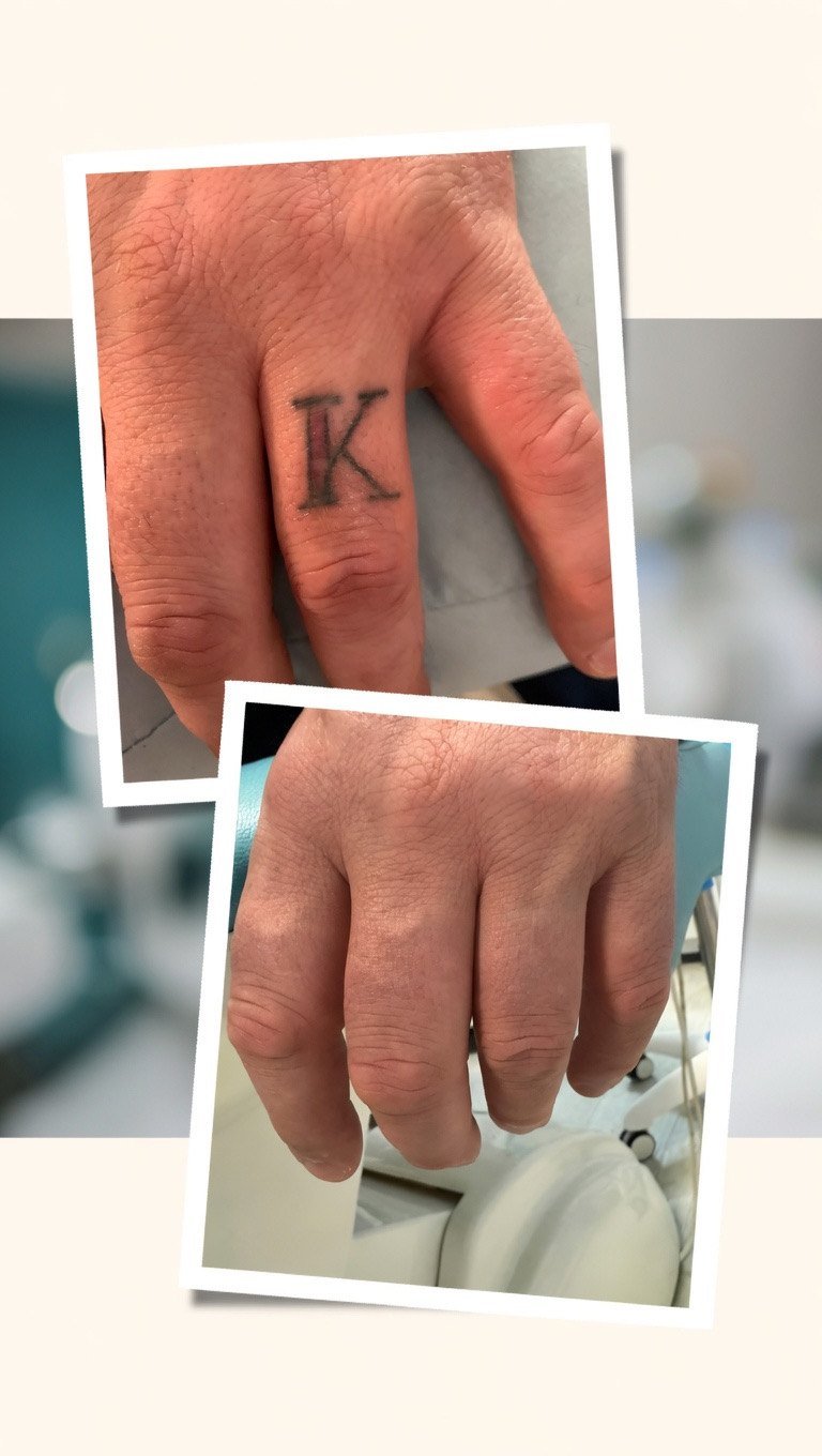 Letter K finger tattoo before and after laser removal at Skintastic