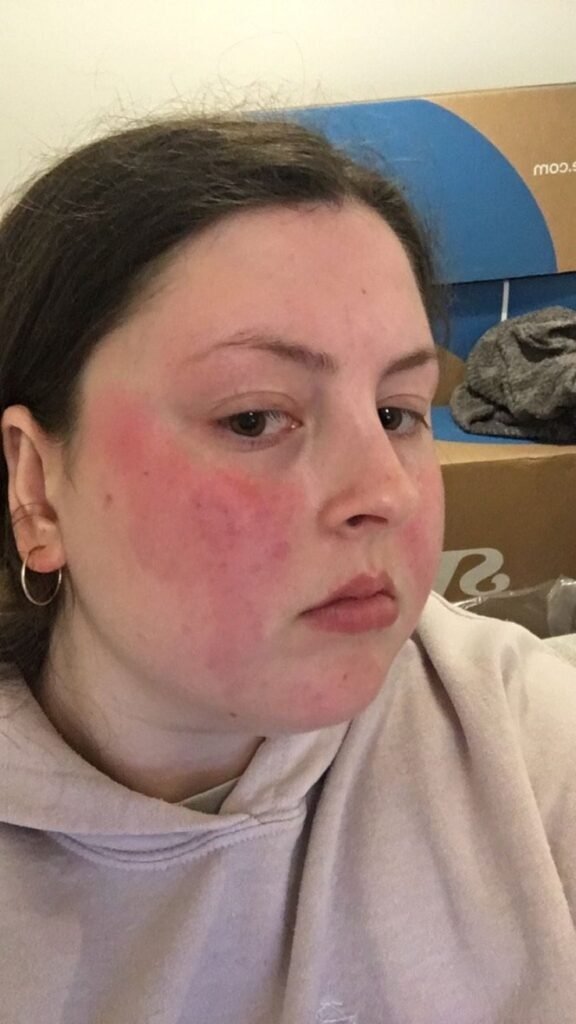 Before and after acne treatment results at Skintastic Aesthetics