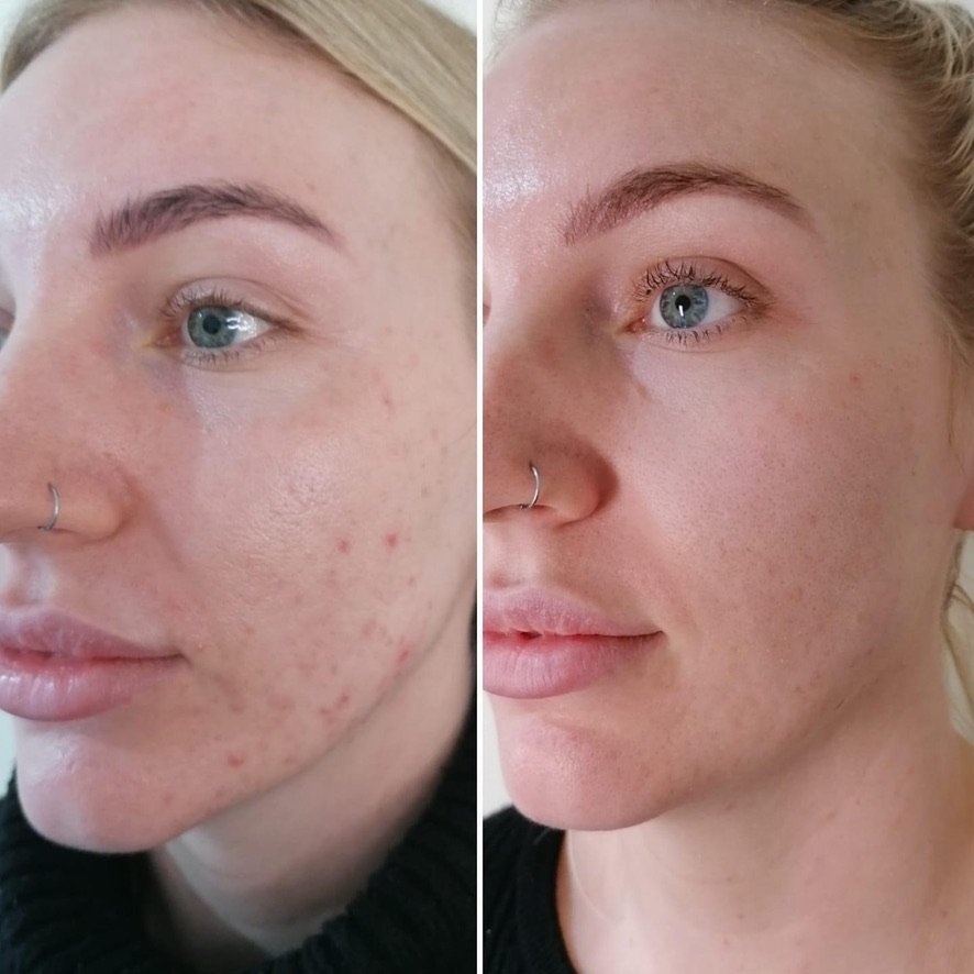 Before and after acne treatment results at Skintastic Aesthetics
