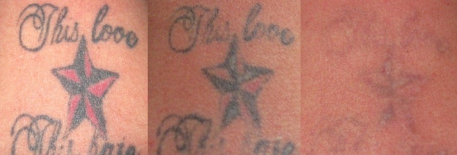 Laser tattoo removal progression over three stages at Skintastic Aesthetics, Southampton