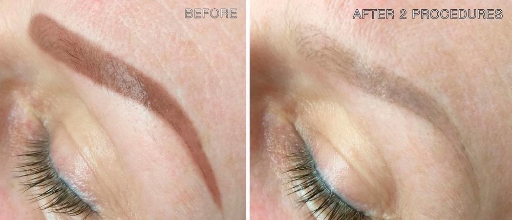 Before and after semi-permanent makeup brow removal at Skintastic Aesthetics, Southampton