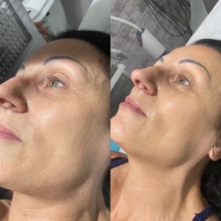 Before and after carbon facial treatment at Skintastic Aesthetics