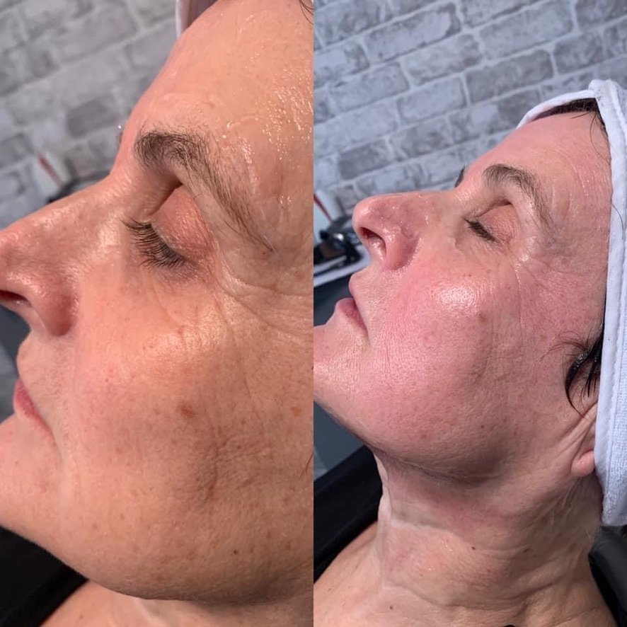 Before and after carbon facial treatment at Skintastic Aesthetics