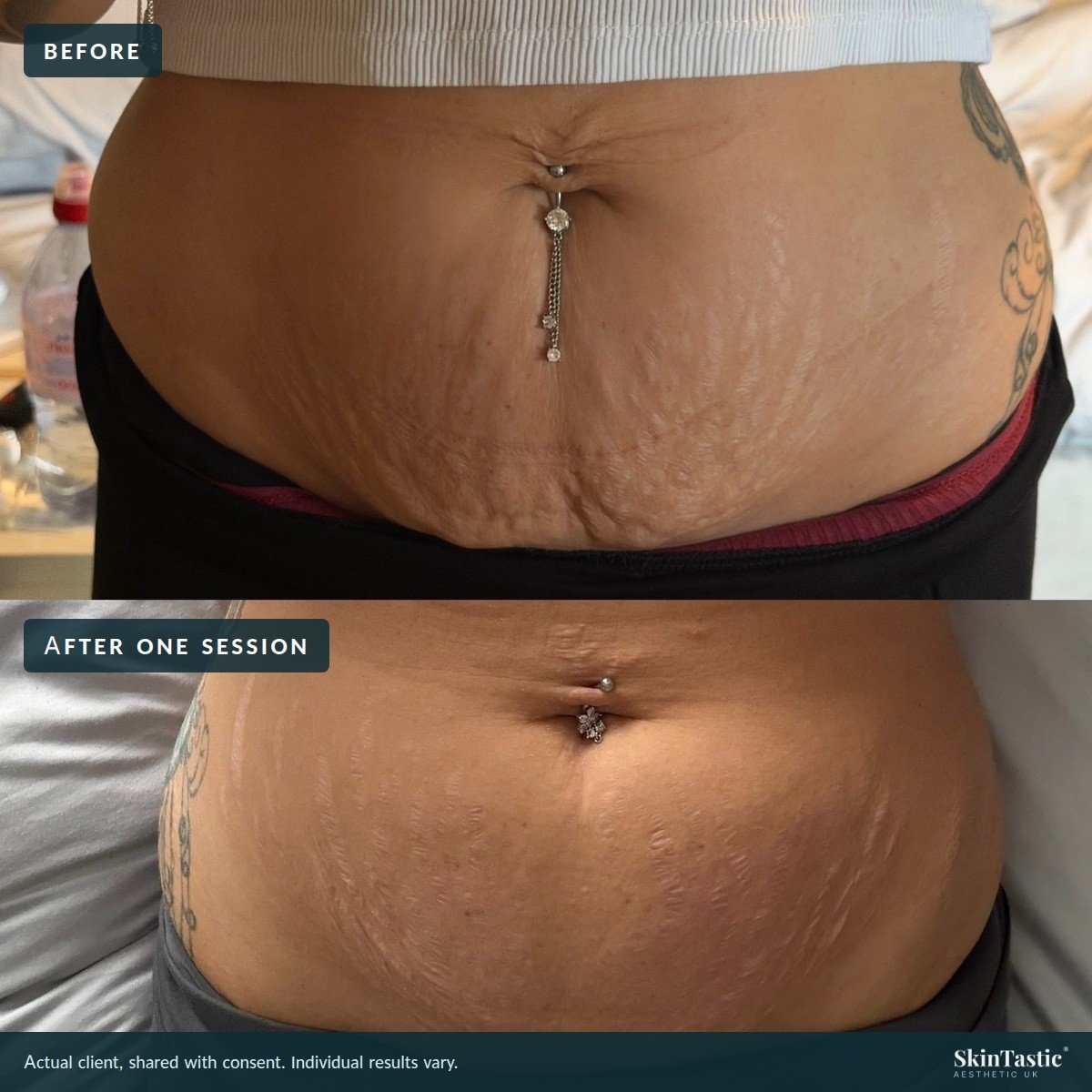 Before and after abdomen photographs of a client treated with the CO2 fractional laser at Skintastic in Southampton, one session, shared with consent, individual results vary