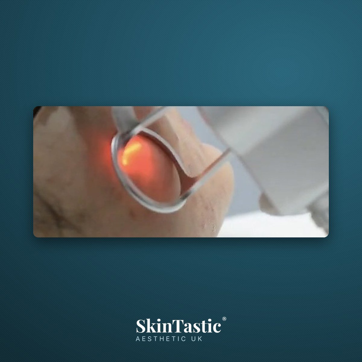 CO2 fractional laser being used for facial skin resurfacing during practical training
