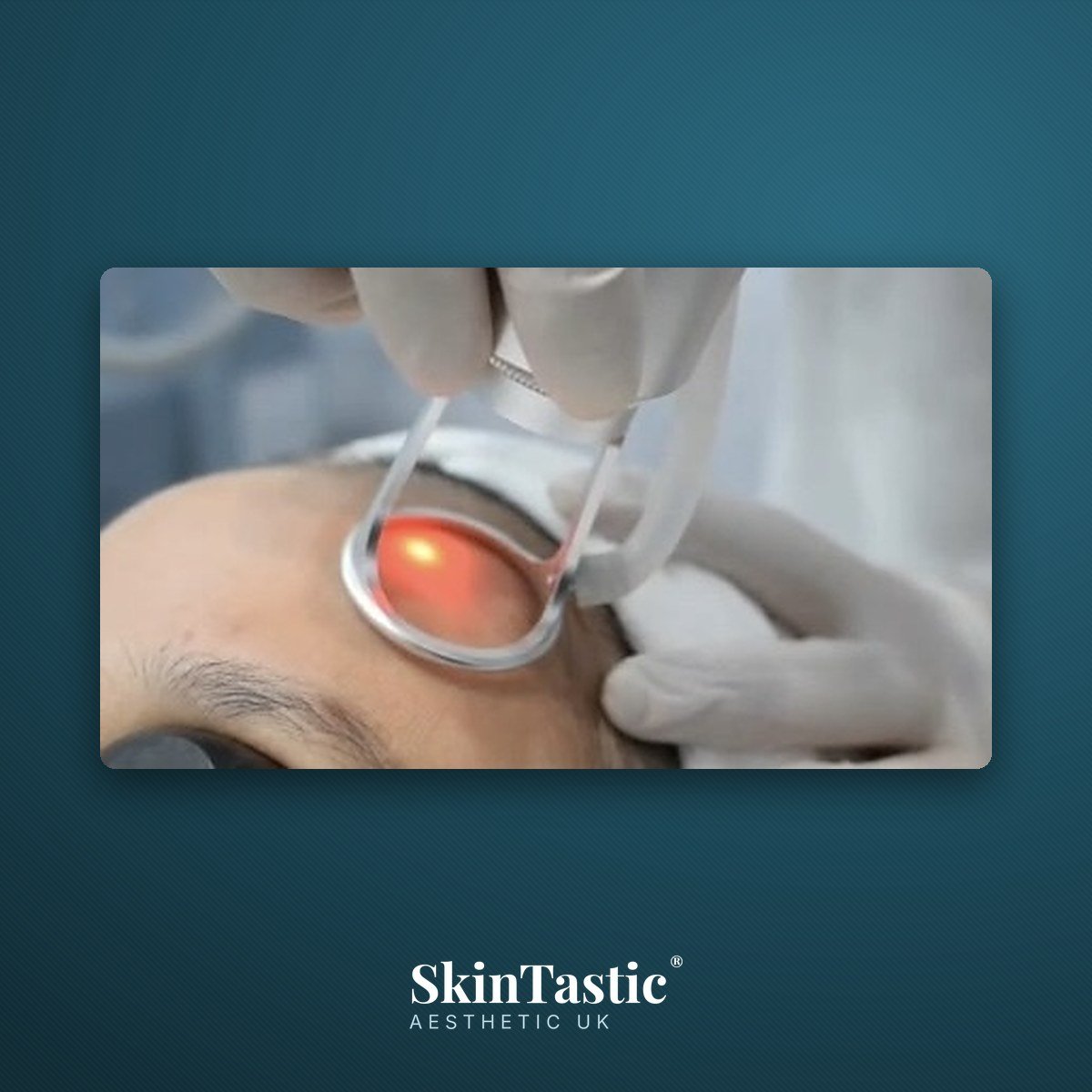CO2 fractional laser handpiece being used on the forehead during hands on training