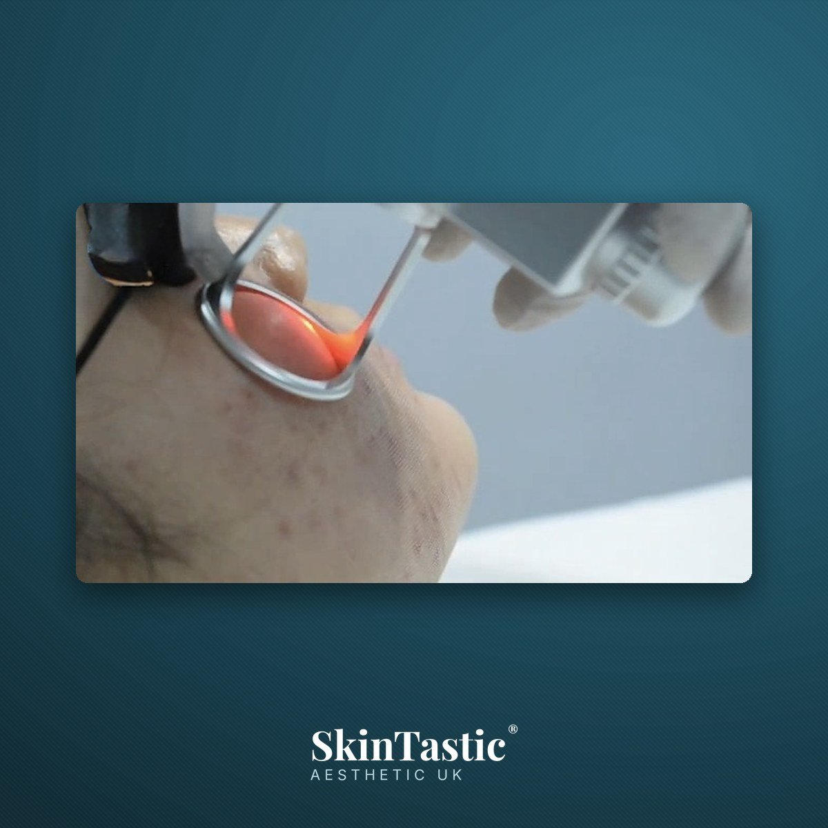 Close view of the fractional pattern delivered by the CO2 laser handpiece during training