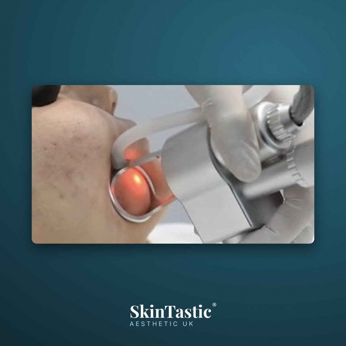 CO2 fractional laser handpiece being used on the neck during supervised practical training