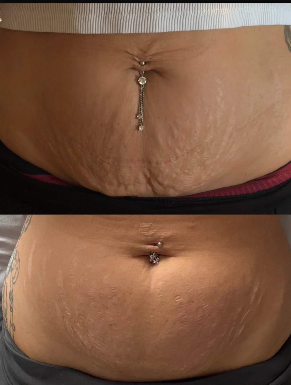 Abdominal stretch marks before and after one CO2 fractional laser session at Skintastic, Southampton