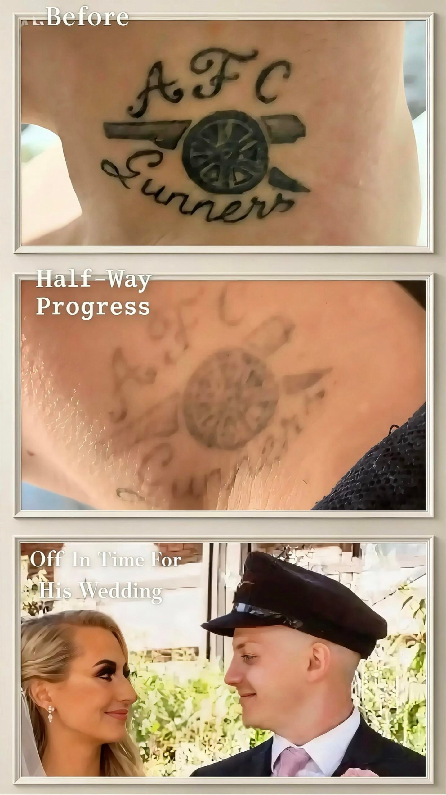 A black tattoo before laser tattoo removal, the same tattoo faded half-way through the course, and the Skintastic client on his wedding day after completing treatment