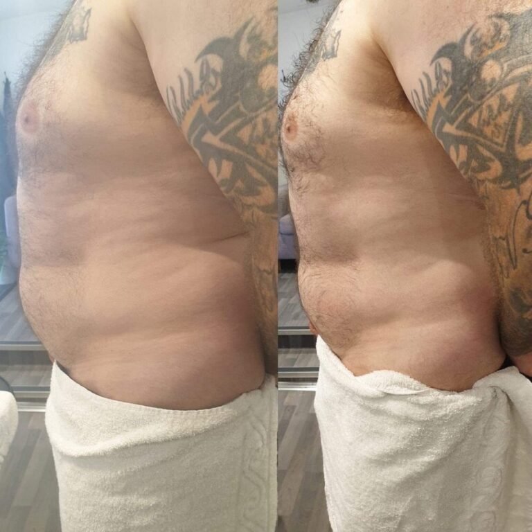 Before and after EMS body sculpting abdominal contouring at Skintastic Aesthetics