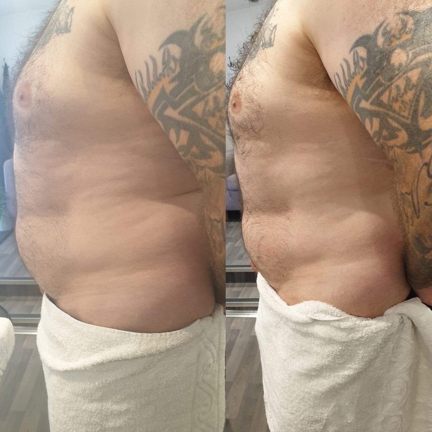 Before and after EMS body sculpting abdominal contouring at Skintastic Aesthetics