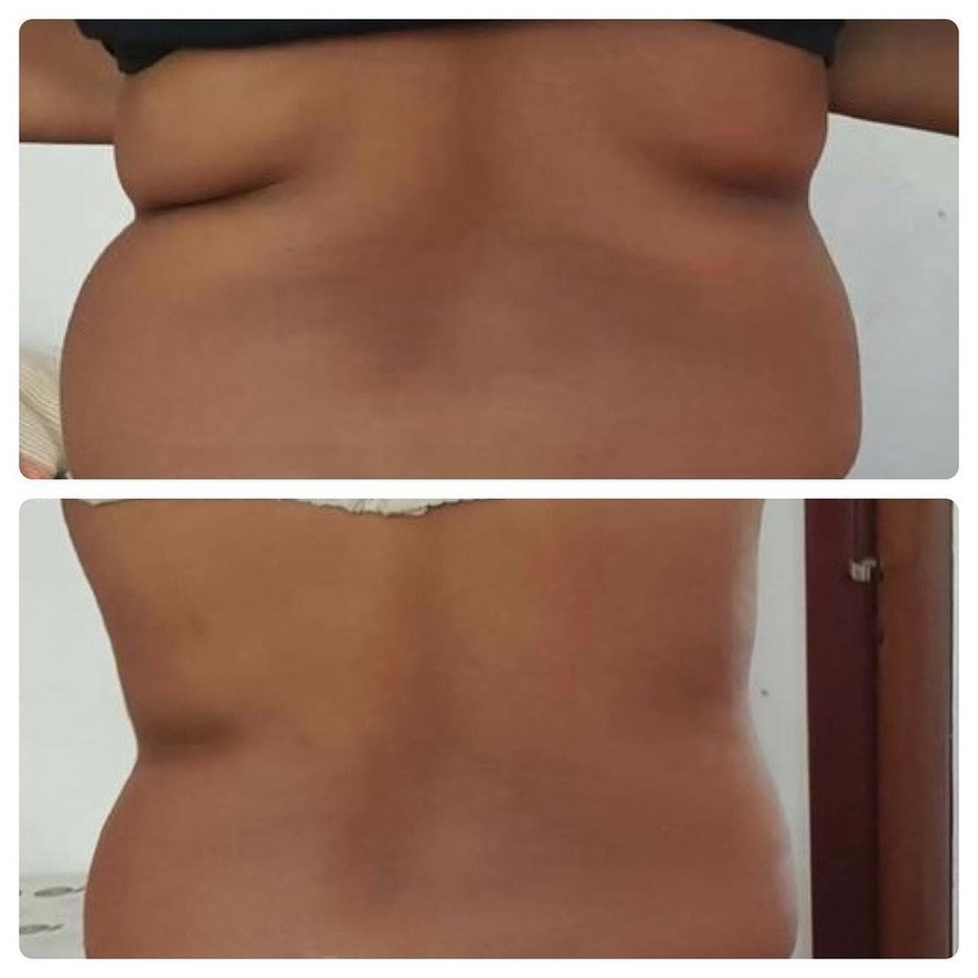 Before and after fat freezing results on the back and flanks at Skintastic Aesthetics