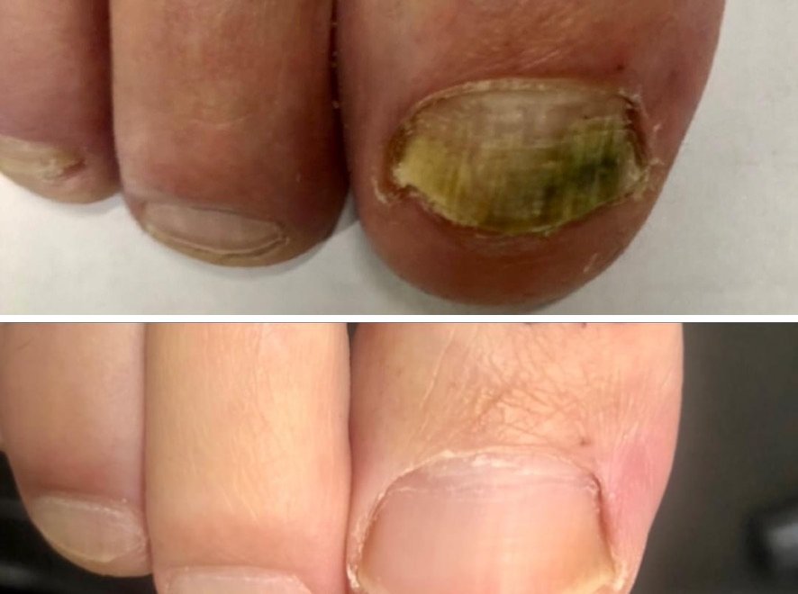 Before and after fungal nail laser treatment