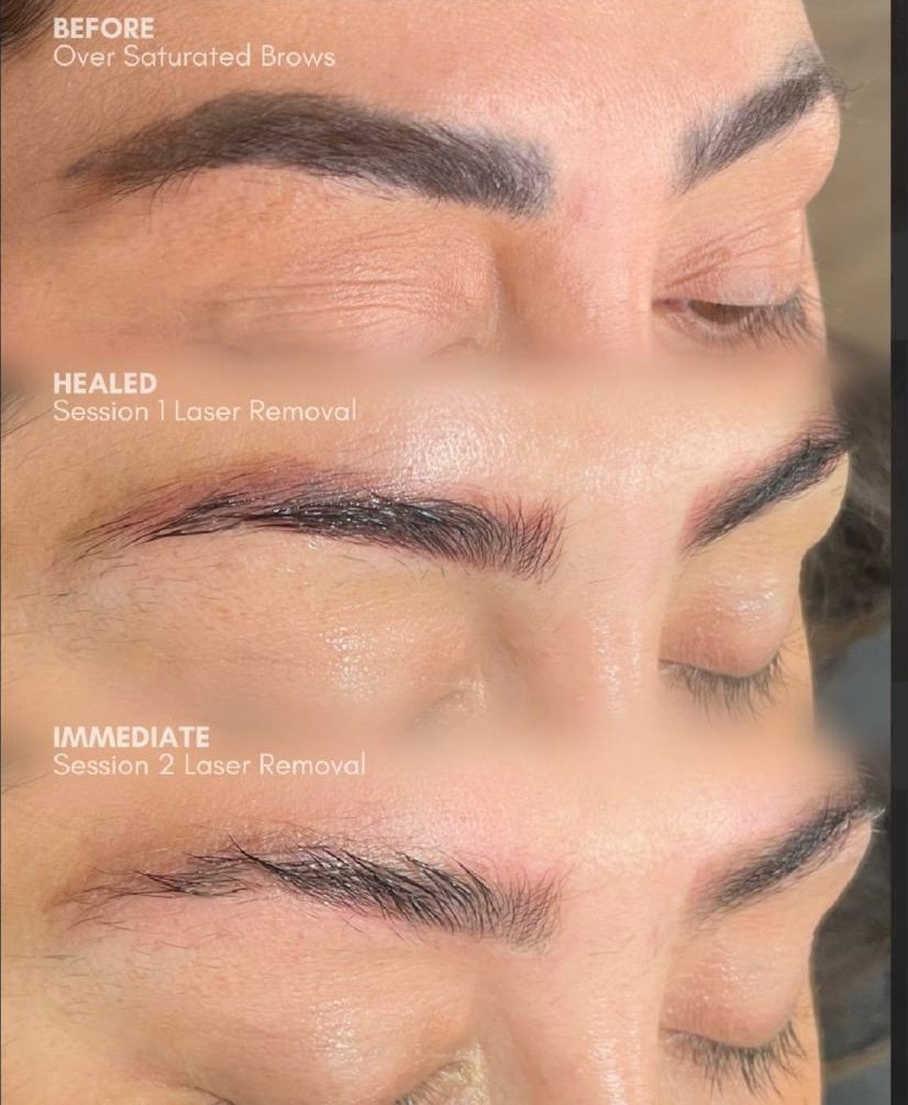 Over saturated semi-permanent makeup brows before laser removal, healed after session one and immediately after session two, treated with a Q-Switched Nd:YAG at Skintastic Southampton