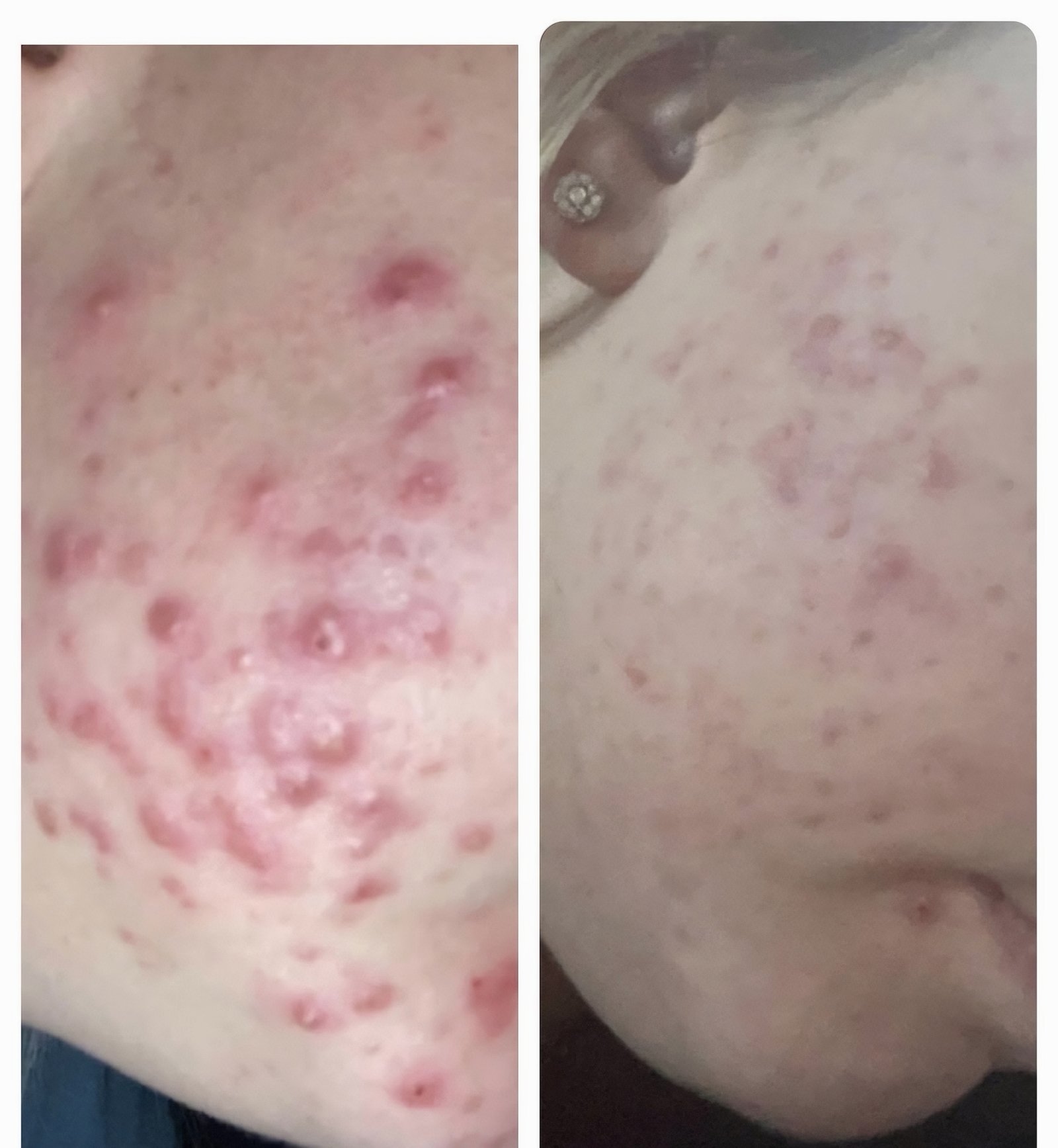 Close-up before and after IPL acne treatment on a Skintastic client, showing inflamed acne spots settling