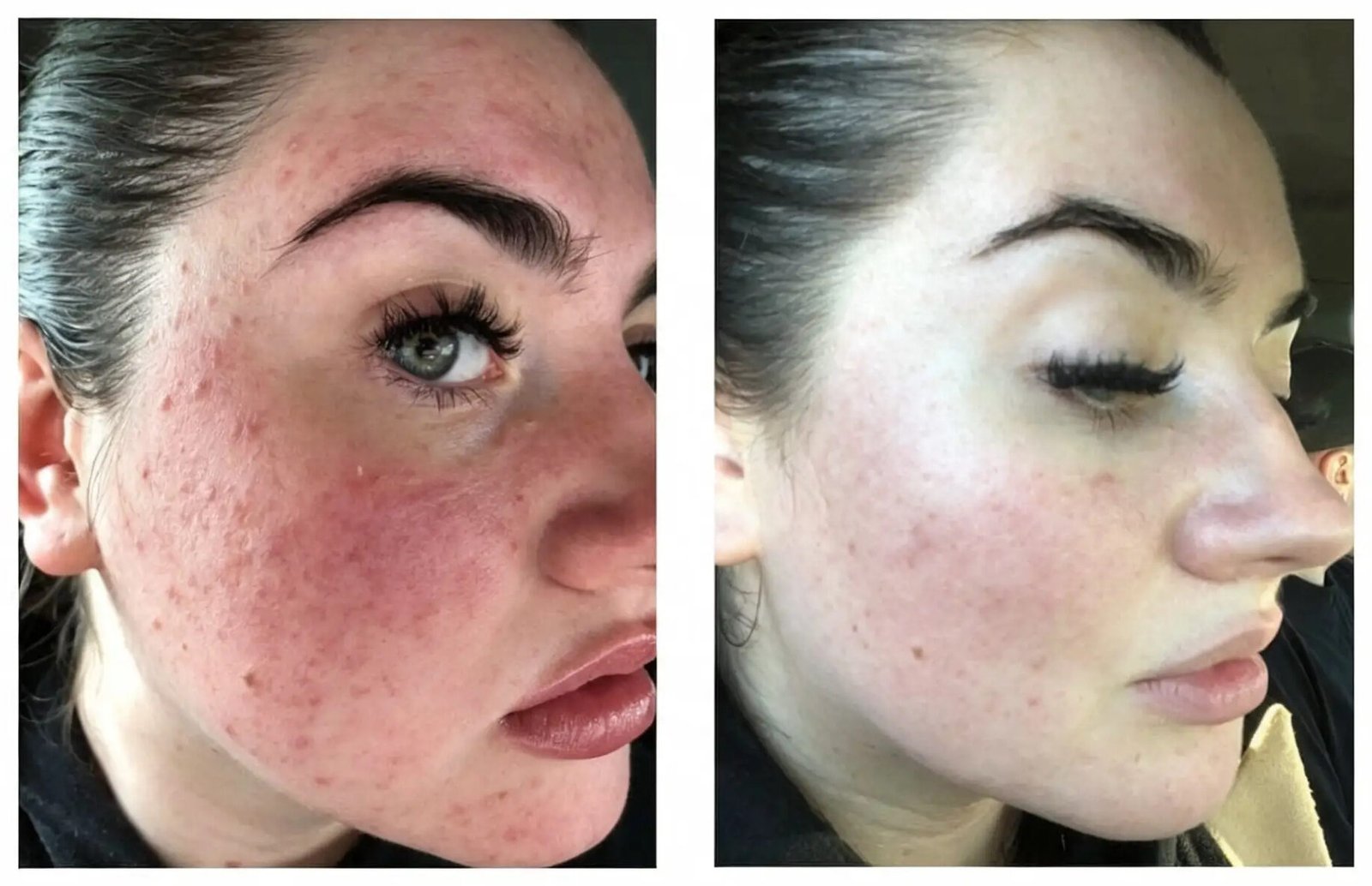 Before and after IPL acne treatment on the cheek of a Skintastic client in Southampton, showing reduced redness and fewer active breakouts