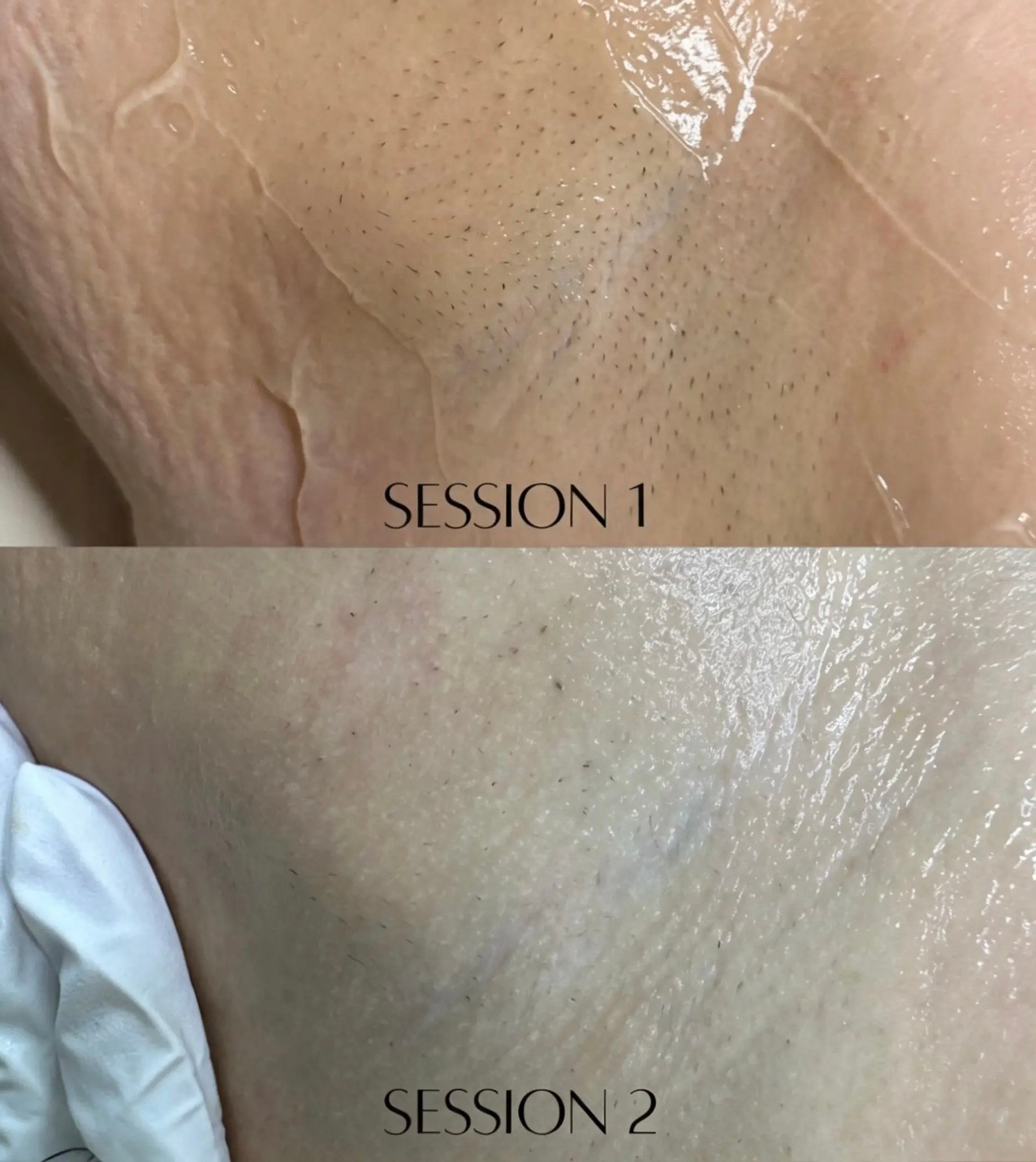 IPL hair removal on the underarm of a Skintastic client, at session one and at session two, showing fewer visible hairs
