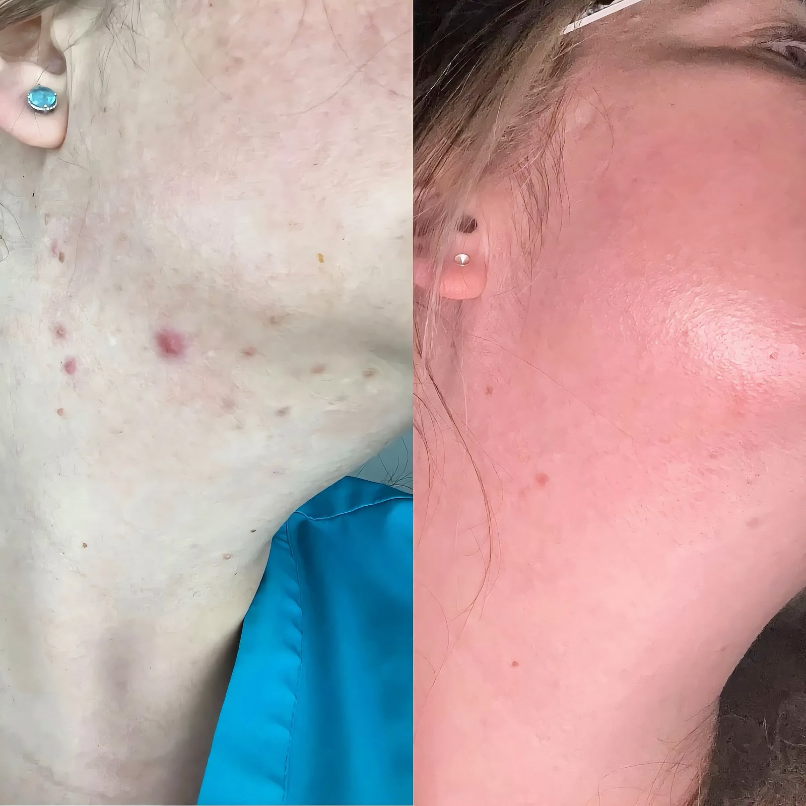 Before and after a course of IPL acne treatment on the jaw and cheek of a Skintastic client in Southampton, showing fewer active spots